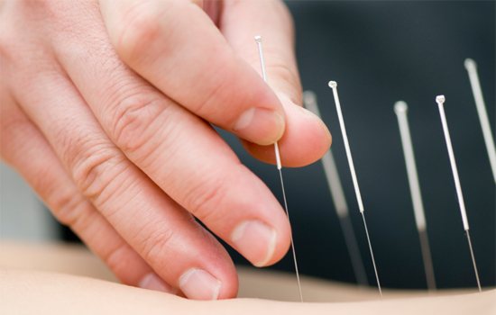 Dry Needling